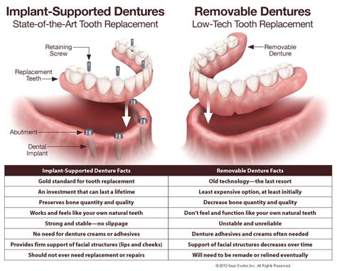 All On 4 Dental Implants Cost 13495 Implants Dentures Chicago