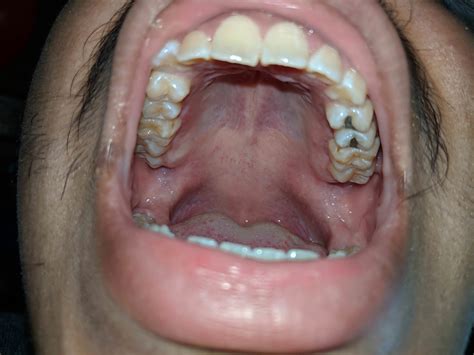 Tiny Bumps On Mouth Roof Mouth Growths Mouth And Dental Disorders