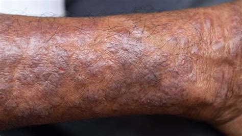 Apresenta O Da Dermatite At Pica Na Pele Negra