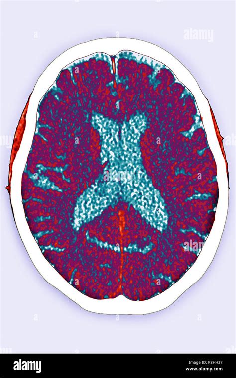 Cerebral Atrophy Ct Scan Stock Photo Alamy