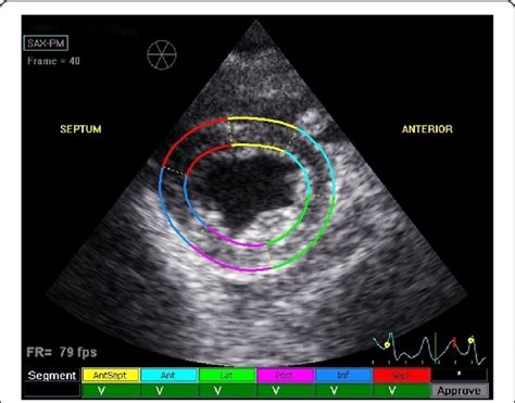 Right Parasternal Short Axis View Of The Left Ventricle At The