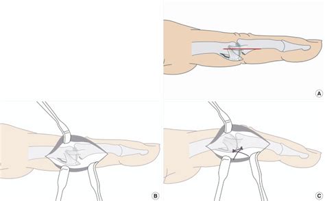 Schematic Drawings Of Surgical Technique A A Midlateral Skin Incision