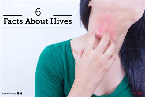 6 Facts About Hives By Dr Prem Kishore Srivastava Lybrate