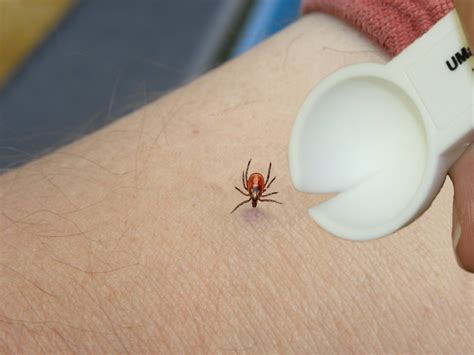 How Do You Remove A Tick From Your Body Without Tweezers Howotremvo