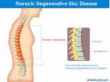 Therapy For Degenerative Disc Disease Photos