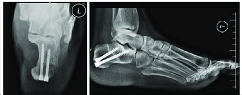 The Anteroposteriorand Lateral View Of Medial Calcaneal Displacement