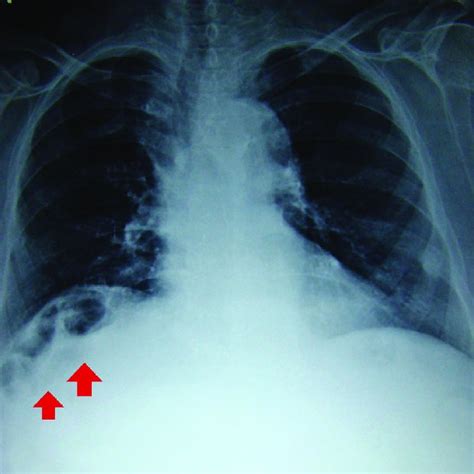 Postero Anterior View Of Chest X Ray Showing Air Under The Diaphragm