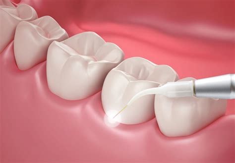 What Is Laser Dentistry And When Is It Used Your Dental Health Resource