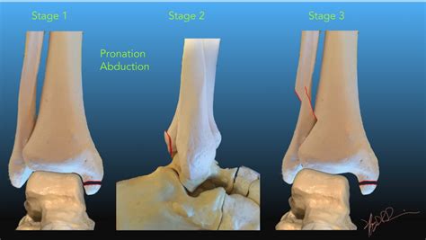 Lauge Hansen Classification Of Ankle Fractures UW Emergency Radiology