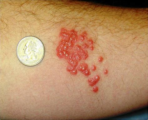What Do Bed Bug Bites Look Like Rashes Symptoms And Treatment My Xxx Hot Girl