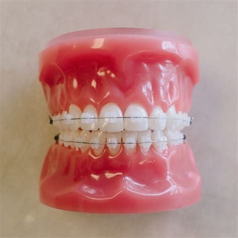 Fixed Ceramic Braces Tom Houlihan Orthodontics