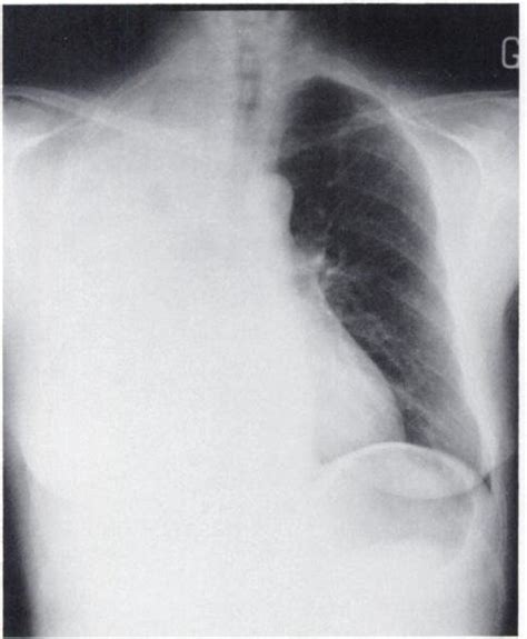 Chest X Ray Showing Large Right Pleural Effusion Download Scientific