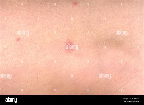 Henoch Schonlein Purpura Anaphylactoid Purpura Spots On A 10 Year Old