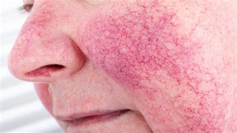 How Different Rosacea Types Are Treated According To A Derm