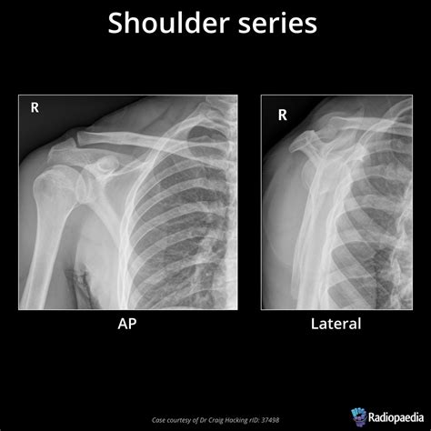 Lateral Shoulder Joint