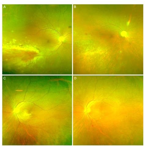 Fundus Photographs Of Both Eye In Case 2 Patient A Fundus Photograph