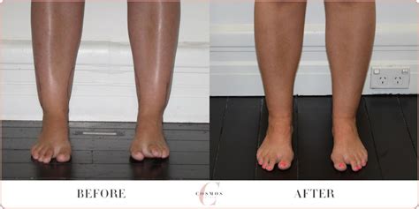 Kneescalvesankles Liposuction Before And After