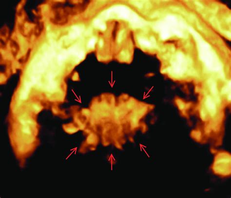 Three Dimensional Ultrasound Of The Soft Palate Arrows At 32 Weeks Of
