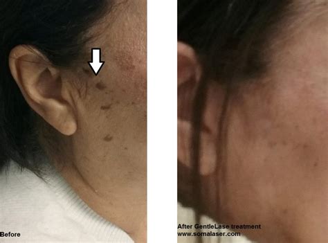 Seborrheic Keratosis Removal In New Jersey Soma Skin And Laser