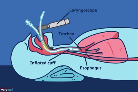 Nasal Endotracheal Intubation Under Fibreoptic Endoscopic SexiezPicz