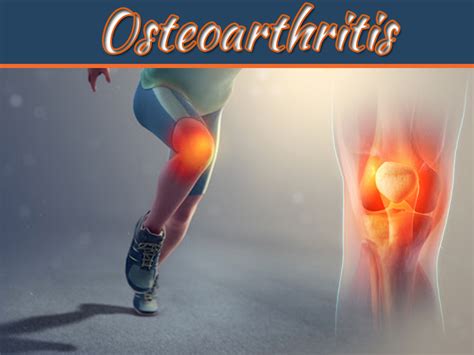 What Is Osteoarthritis 9 Causes And Treatment Options To Get Rid Of It