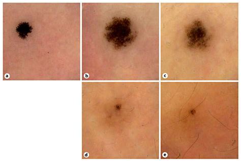 Dermoscopic Views Of A Pigmented Spitz Nevus Located On The Leg Of An