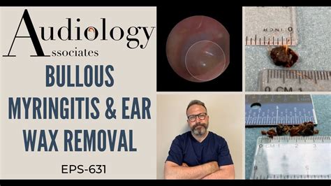 Bullous Myringitis And Earwax Removal Ep631 Youtube