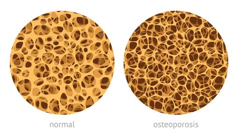 Bone Density Vs Bone Quality Is There A Difference