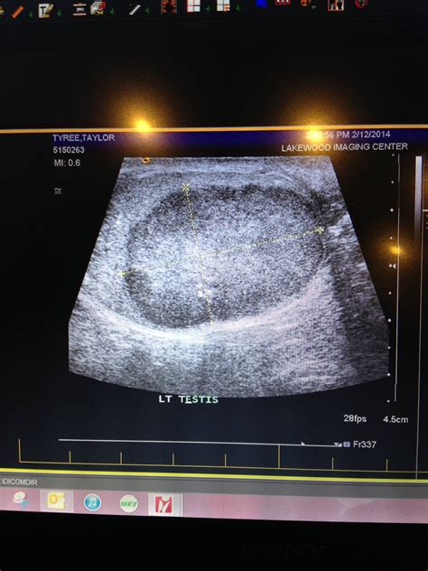 It can help to think of it this way: Guy with testicular cancer is certain Reddit saved his ...