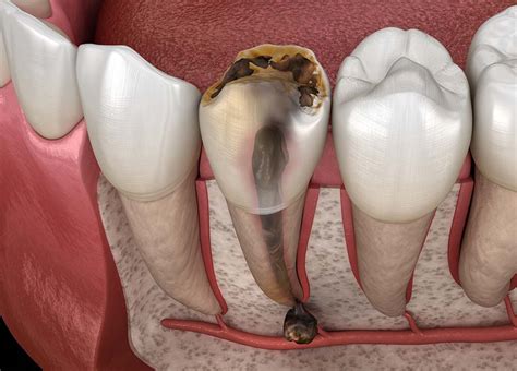 Dental Cyst Treatment In Miami
