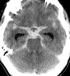 Subarachnoid Hemorrhage What The Patient Needs To Know Aaron Cohen