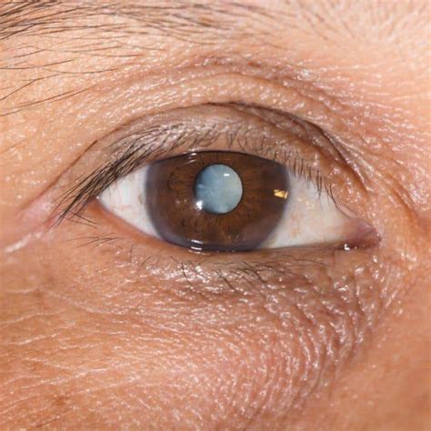 What Is That Light I See After Cataract Surgery Solinsky Eyecare