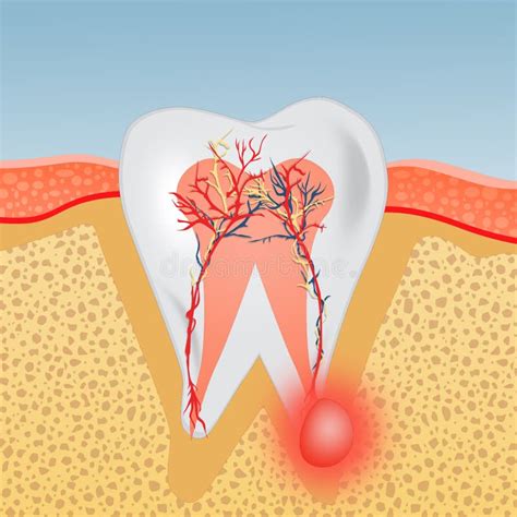 Abscess Tooth Vector Illustration Labeled Medical Diagram With