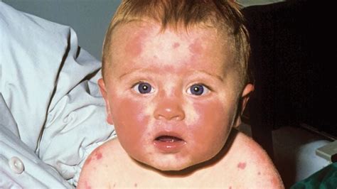 10 Common Rashes On Kids With Photos Todays Parent