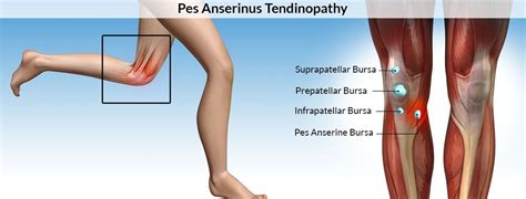 Pin By Zhongba Hospital Lahore On Physiotherapy Hospital Sartorius Muscle Bursitis Medical