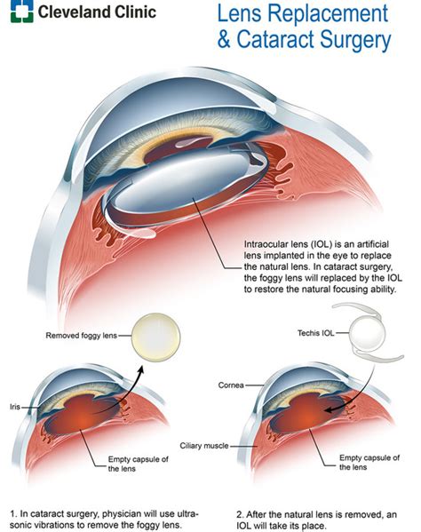 Cataract Surgery Procedure Safety Recovery And Effects