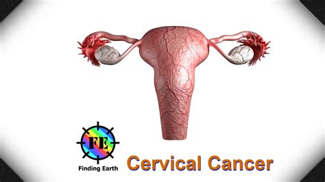 Symptoms of advanced cervical cancer cervical cancer may spread (metastasize) within the pelvis, to the lymph nodes, or form tumors elsewhere in the body. Cervical Cancer - Symptom, Causes & Diagnosis (Finding ...