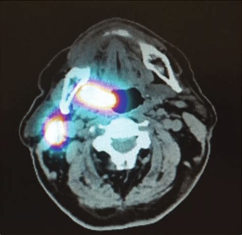 Spect Ct And Lymphoscintigraphy Fusion Right Tonsillar Tumor With A