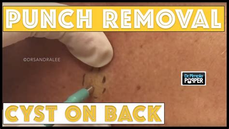 Punch Removal Of A Cyst On A Patient With Tinea Versicolor Youtube