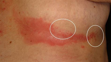 intertrigo intertrigo rash on elderly woman s groin stock image m180 0075 science photo