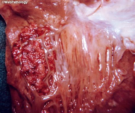Thrombi may occur anywhere in the body. Webpathology.com: A Collection of Surgical Pathology Images