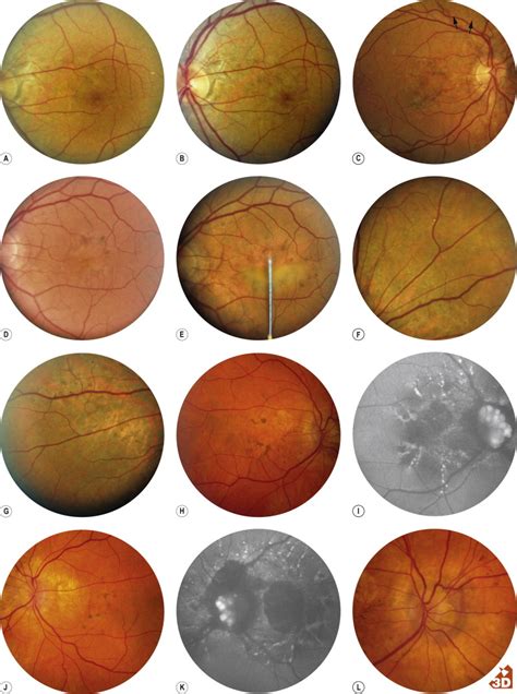 Diseases Causing Exudative And Hemorrhagic Detachment Of The Choroid