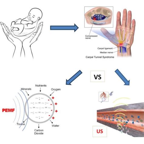 Carpal Tunnel Syndrome Pemf Education