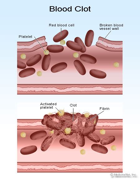 As many as 60 percent of people with a blood clot in a deep vein of the arm may experience no symptoms at all, according to the same 2017 review.symptoms may also come on gradually. Blood Clots Symptoms & Signs (Leg, Lung), and Pictures