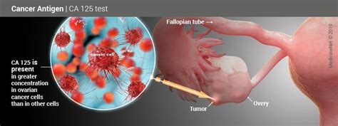 These extra cells may form a mass of tissue, called a tumor. CA 125: Ovarian Tumor Marker Blood Test Results