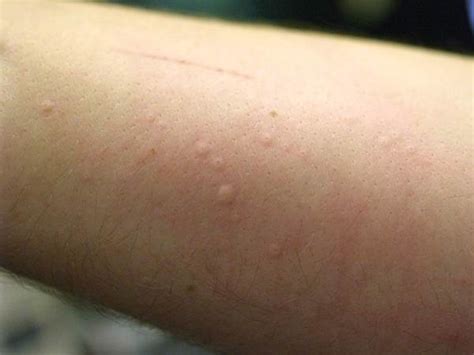 Human Skin Allergy To Cats Cat Allergy Skin Rash Hives Itchy Eyes Red