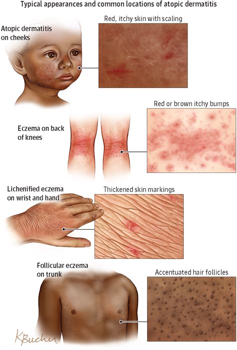 Atopic Dermatitis Allergy And Clinical Immunology Jama Dermatology Jama Network