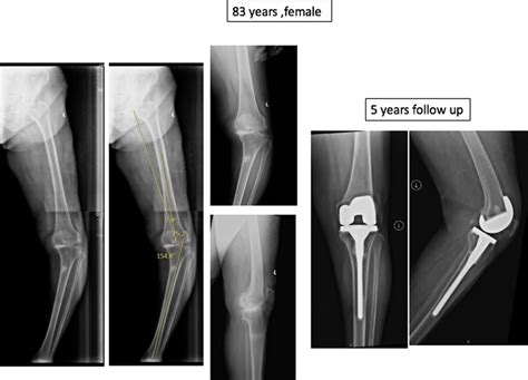 Chronic Proximal Tibial Stress Fracture Treated With Long Stem Tka