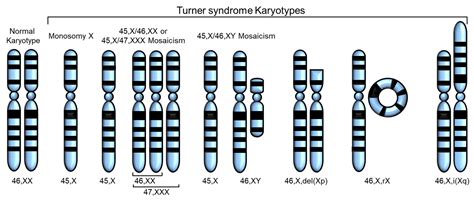 Organ Abnormalities Caused By Turner Syndrome Encyclopedia Mdpi