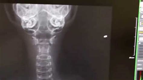 X Rays Of A Kitten With A Very Painful Throat Youtube